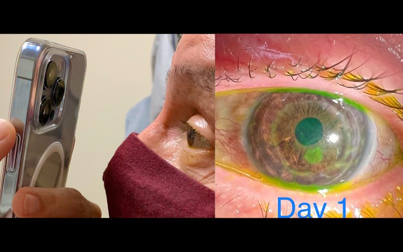 醫生使用 iPhone 13 Pro 微距攝影檢查病人眼睛