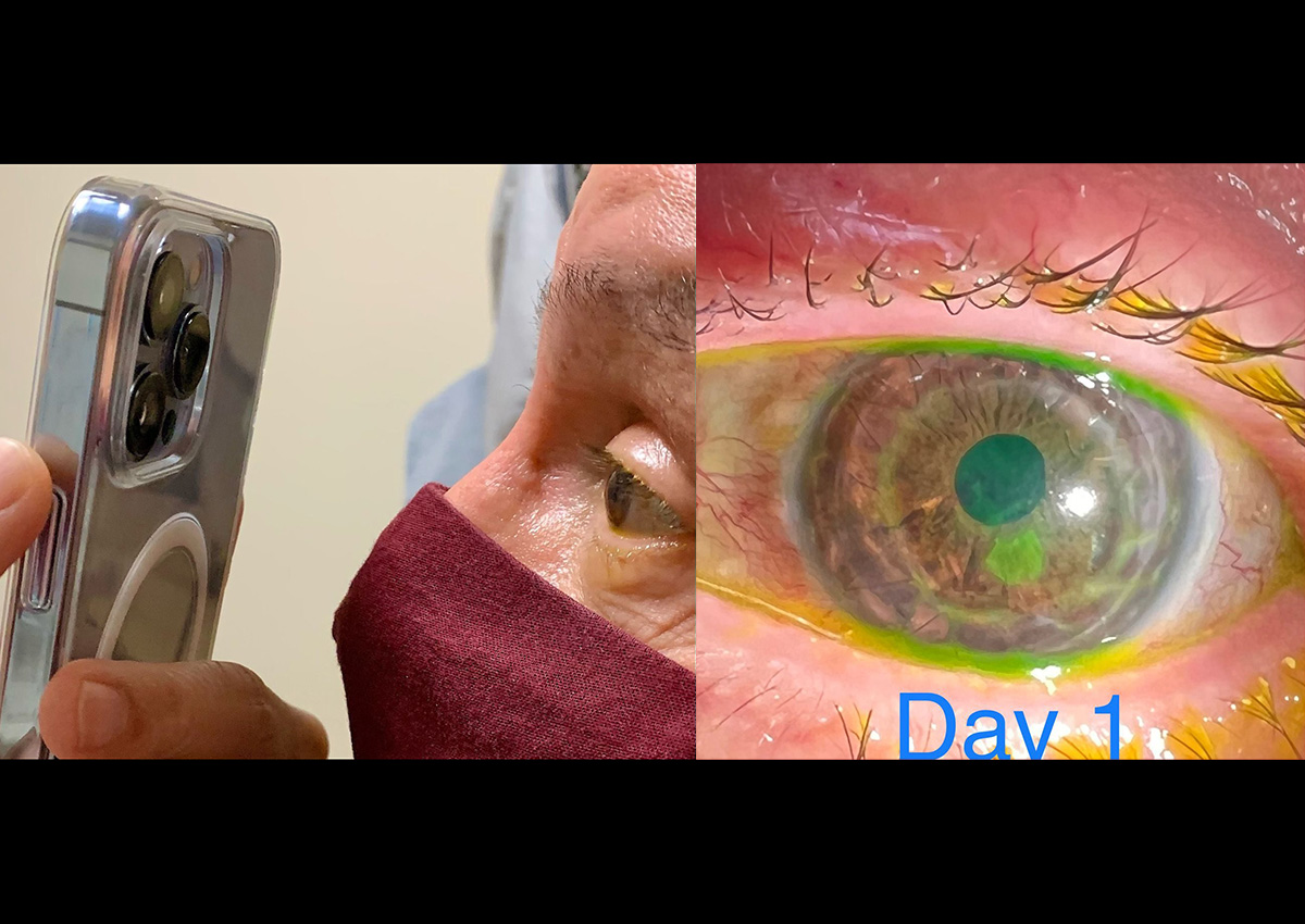 醫生使用 iPhone 13 Pro 微距攝影檢查病人眼睛